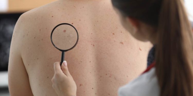 Hautkrebs-Screening im Herzogtum Lauenburg immer weniger genutzt
